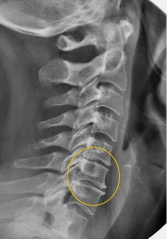 Emakakaela lülisamba osteokondroos x -ray